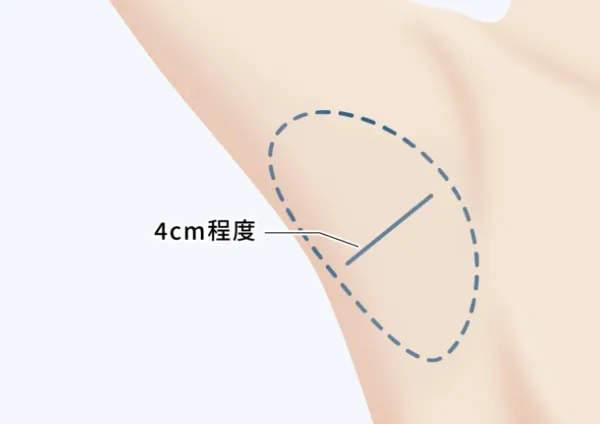 手術デザイン