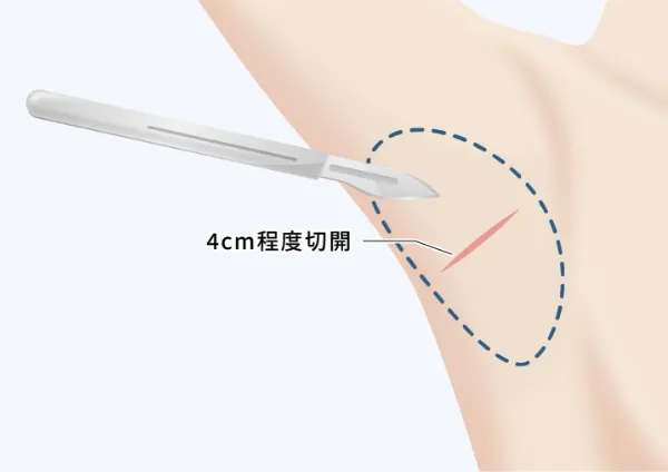 皮膚切開と皮膚剥離