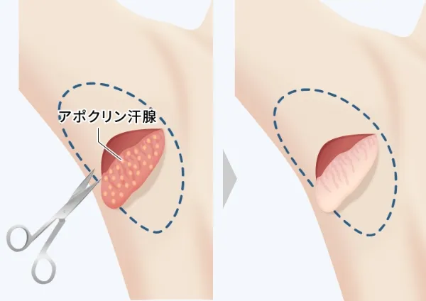 アポクリン腺の除去